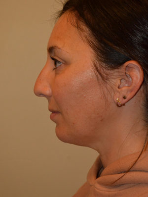 Chin Implants Case 15431 After Photo Chin Implants