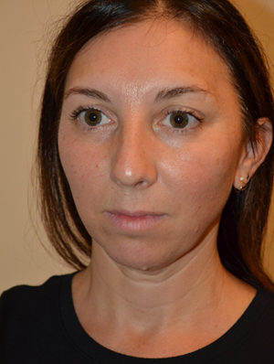Chin Implants Case 15431 Before Photo Chin Implants