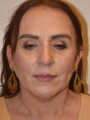 Nose Surgery Case 15414 After Photo Nose Surgery