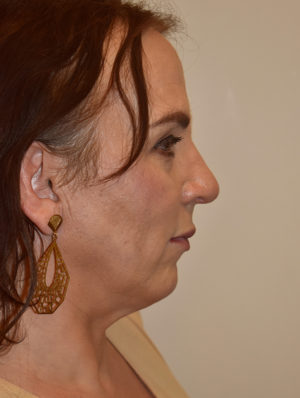 Nose Surgery Case 15414 After Photo Nose Surgery