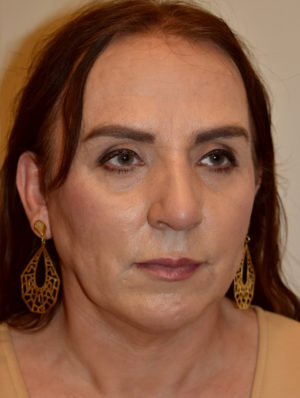 Nose Surgery Case 15414 After Photo Nose Surgery
