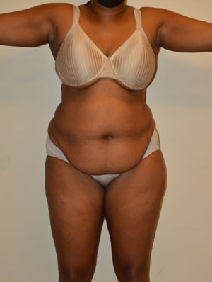 Tummy Tuck Case 15539 Before Photo Tummy Tuck