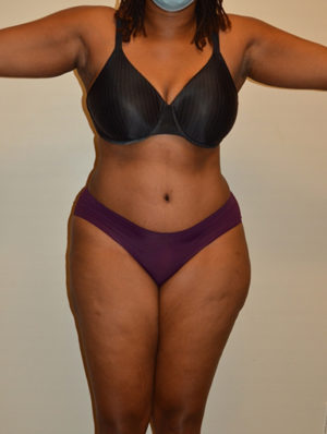 Tummy Tuck Case 15539 After Photo Tummy Tuck
