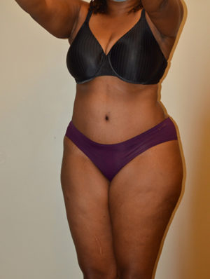Tummy Tuck Case 15539 After Photo Tummy Tuck
