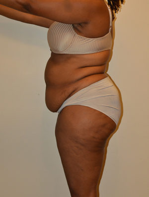 Tummy Tuck Case 15539 Before Photo Tummy Tuck