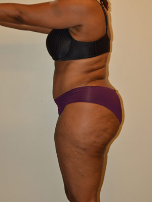 Tummy Tuck Case 15539 After Photo Tummy Tuck