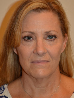 Facelift and Necklift Case 15480 Before Photo Facelift and Necklift