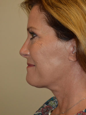 Facelift and Necklift Case 15480 After Photo Facelift and Necklift