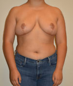 Breast Reduction