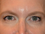 Eyelid Surgery