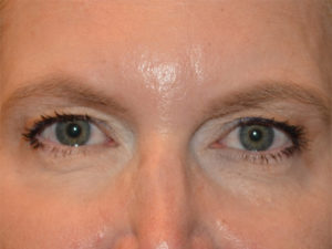Eyelid Surgery Case 15605 Before Photo Eyelid Surgery