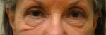 Eyelid Surgery