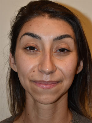 Chin Implants Case 15630 Before Photo Chin Implants