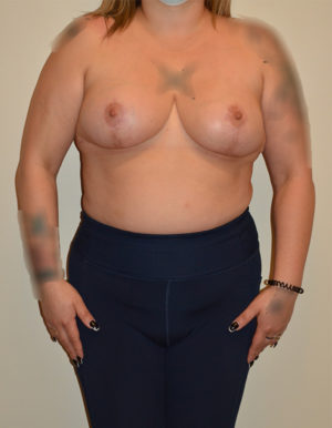 Breast Reduction Case 15598 After Photo Breast Reduction
