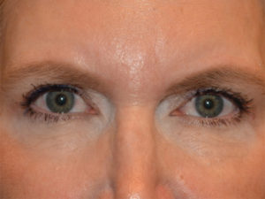 Eyelid Surgery Case 15605 After Photo Eyelid Surgery