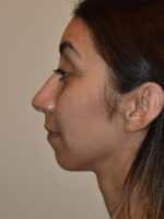 Chin Implants