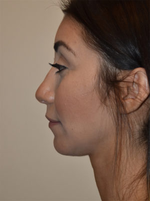 Chin Implants Case 15630 After Photo Chin Implants