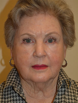 Facelift and Necklift Case 15651 Before Photo Facelift and Necklift