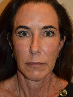 Facelift and Necklift Case 15637 Before Photo Facelift and Necklift