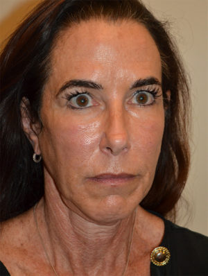 Facelift and Necklift Case 15637 Before Photo Facelift and Necklift