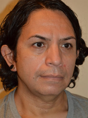 Facial Feminization Case 15644 Before Photo Facial Feminization