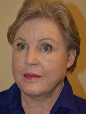 Facelift and Necklift Case 15651 After Photo Facelift and Necklift