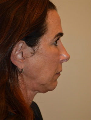 Facelift and Necklift Case 15637 Before Photo Facelift and Necklift
