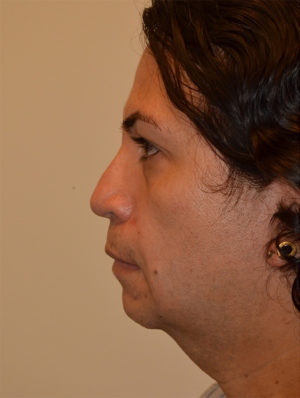 Facial Feminization Case 15644 Before Photo Facial Feminization