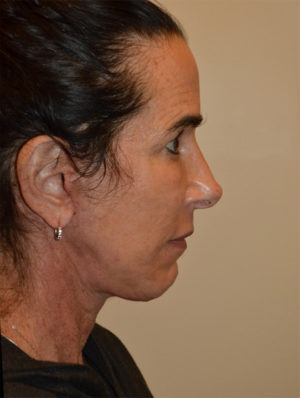 Facelift and Necklift Case 15637 After Photo Facelift and Necklift