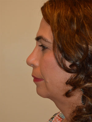 Facial Feminization Case 15644 After Photo Facial Feminization