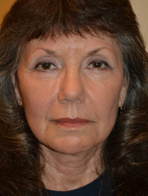 Facelift and Necklift