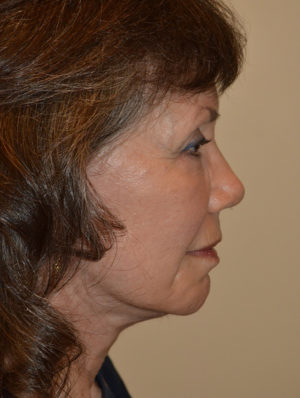 Facelift and Necklift