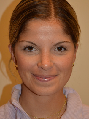 Nose Surgery Case 15686 After Photo Nose Surgery