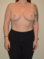 Breast Reduction