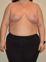 Breast Reduction