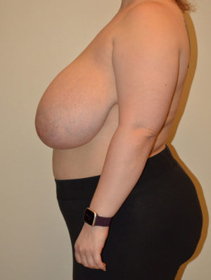 Breast Reduction Case 15697 Before Photo Breast Reduction