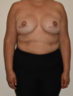 Breast Reconstruction