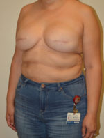 Breast Reconstruction