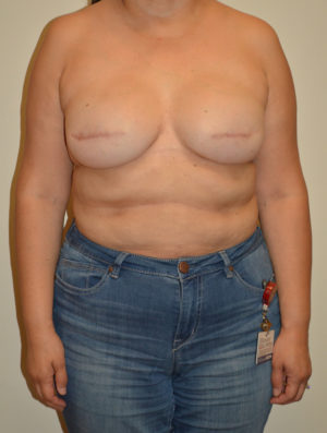 Breast Reconstruction Case 15742 Before Photo Breast Reconstruction
