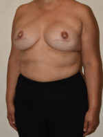 Breast Reconstruction