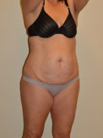 Tummy Tuck