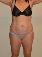 Tummy Tuck