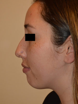 Chin Implants