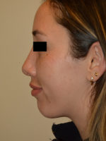 Nose Surgery