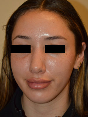 Nose Surgery Case 15766 After Photo Nose Surgery