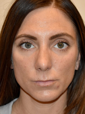 Nose Surgery Case 15775 After Photo Nose Surgery