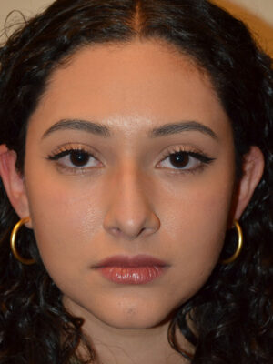 Nose Surgery Case 15891 Before Photo Nose Surgery