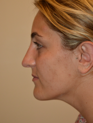 Nose Surgery Case 15892 After Photo Nose Surgery