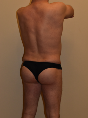Buttock Augmentation Case 15974 After Photo Buttock Augmentation