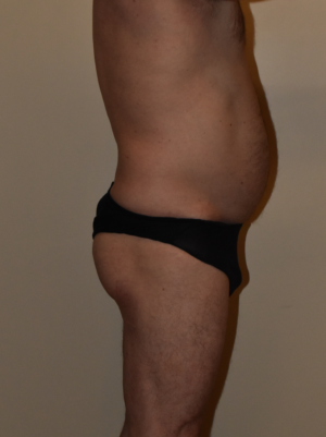 Buttock Augmentation Case 15974 Before Photo Buttock Augmentation
